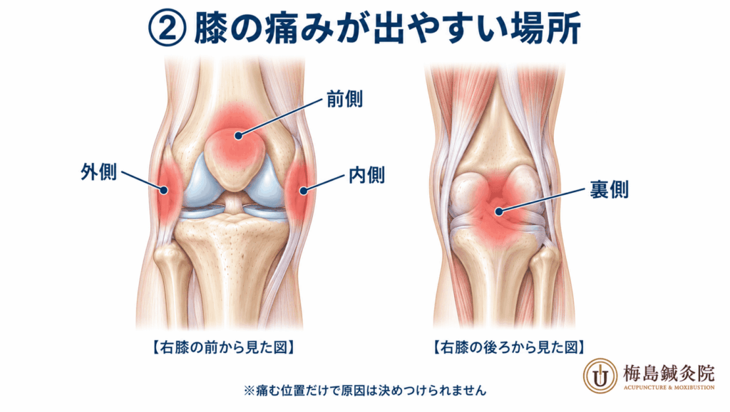 膝の痛む場所