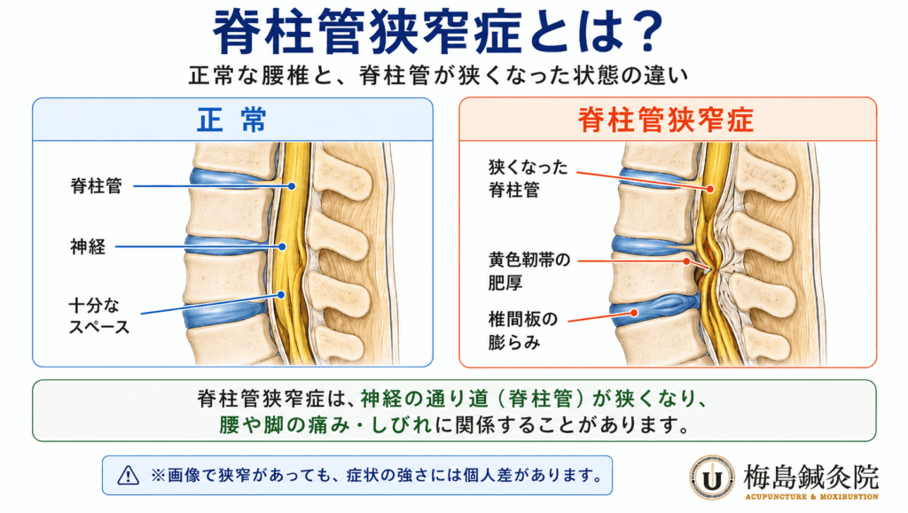 正常な腰椎と、椎間板や黄色靱帯などの変化によって脊柱管が狭くなった状態を比較した図