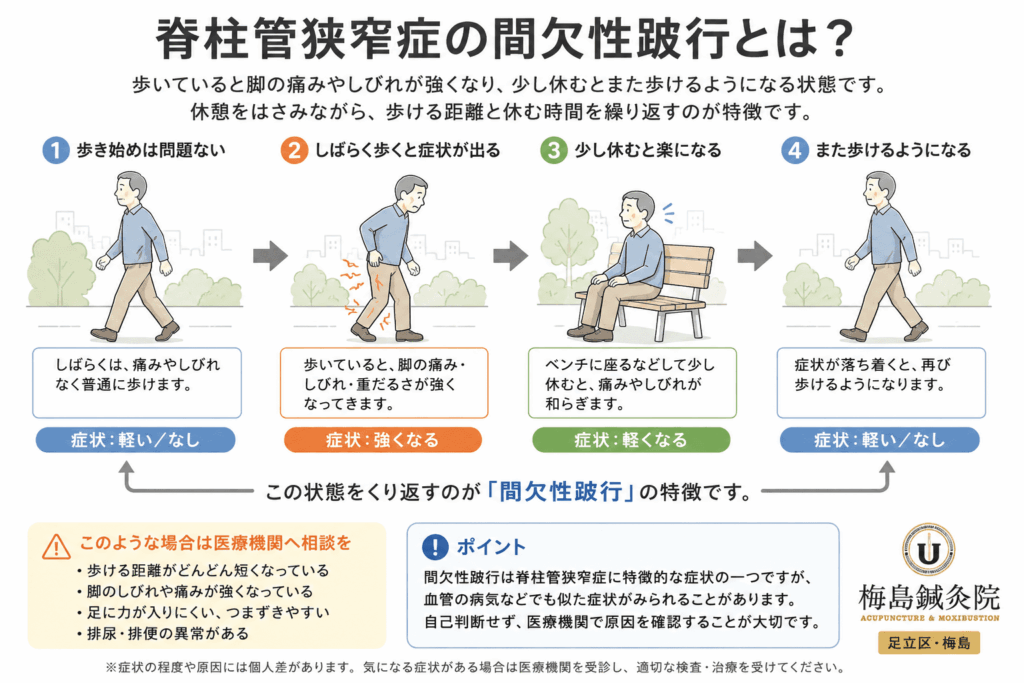 歩行開始→脚の痛み・しびれ→休憩→再び歩行、という間欠性跛行の流れを示した図