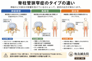 神経根型・馬尾型・混合型について、神経への影響と症状の出やすい範囲を比較した図